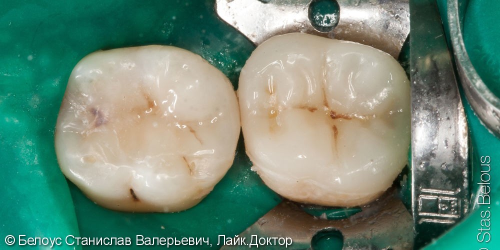 Лечение каналов, установка коронок из стеклокерамики на CAD/CAM - фото №5