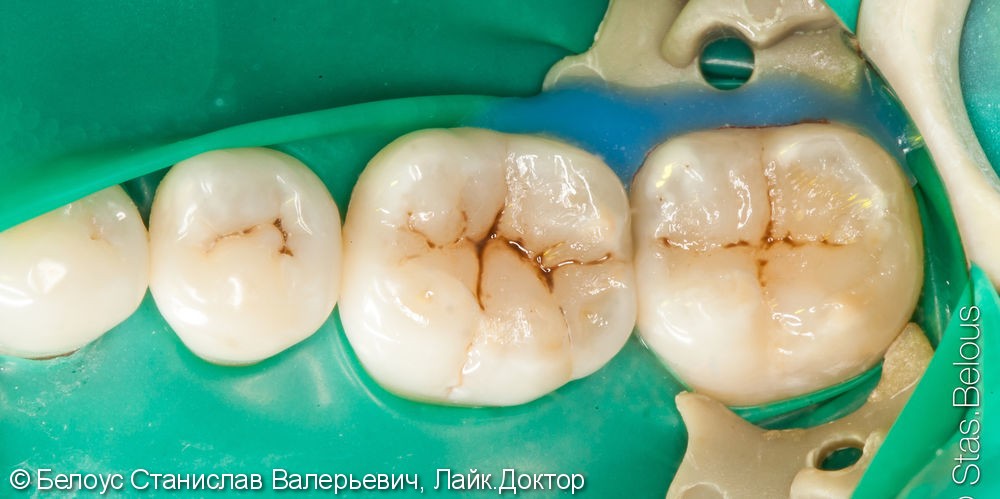 Классика терапевтического лечения на приеме стоматолога - фото №4