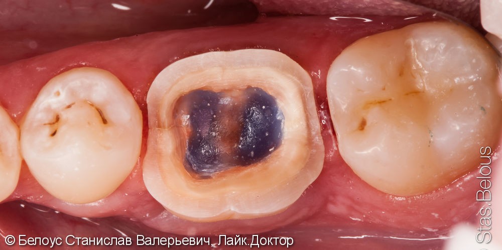 Чистка каналов зуба под микроскопом, установка коронки из немецкого материала Vita Suptinity - фото №2