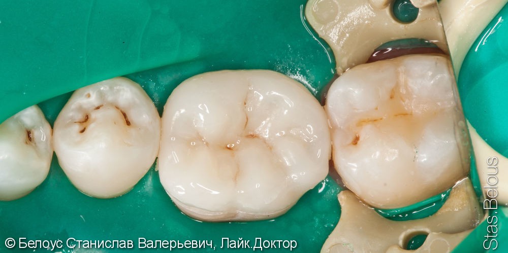 Чистка каналов зуба под микроскопом, установка коронки из немецкого материала Vita Suptinity - фото №5
