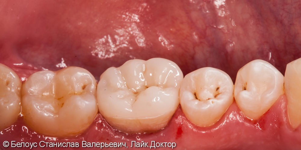 Чистка каналов зуба под микроскопом, установка коронки из немецкого материала Vita Suptinity - фото №7
