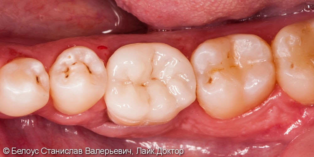 Чистка каналов зуба под микроскопом, установка коронки из немецкого материала Vita Suptinity - фото №8