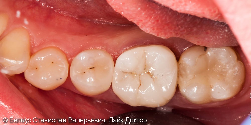 Обострение периодонтита 46 зуба со всеми вытекающими, коронка CAD/CAM Cerec - фото №3