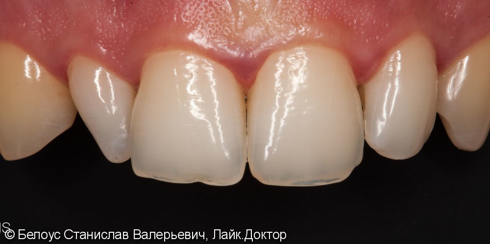 Один винир на шиповидный зуб, до и после - фото №1