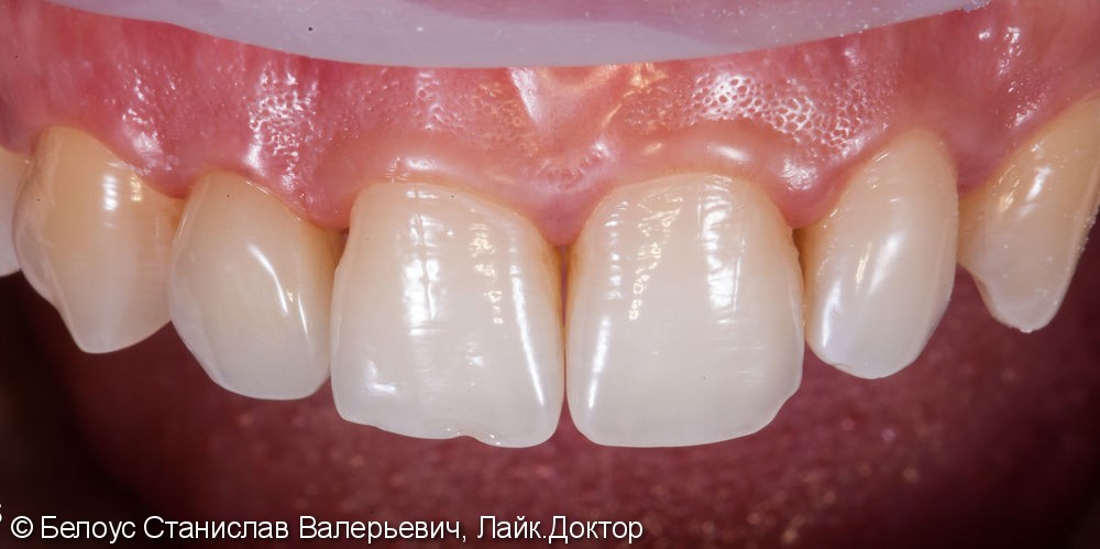 Один винир на шиповидный зуб, до и после - фото №4