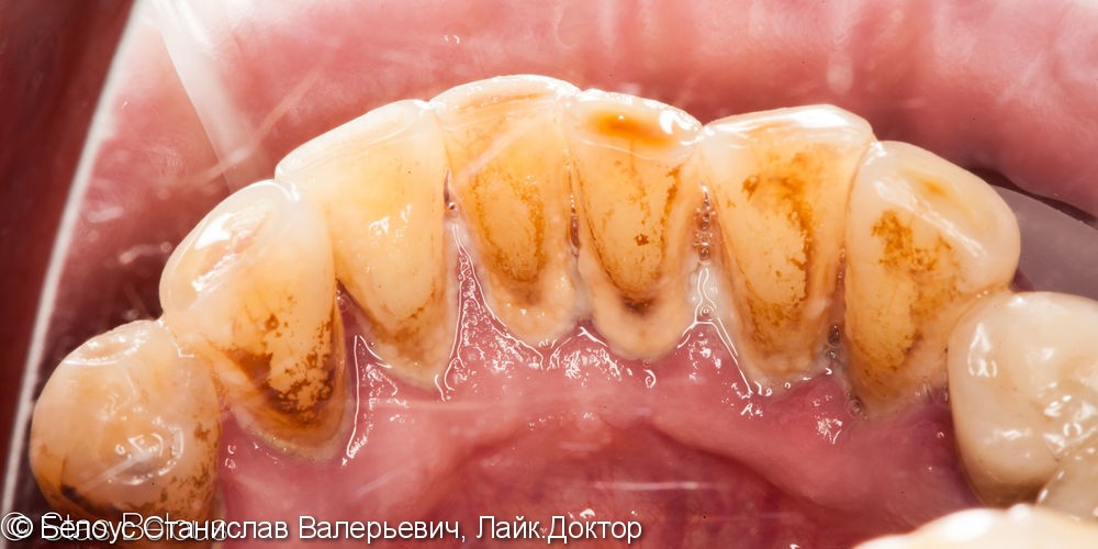 Гигиену полости рта, снятие зубного налета у курильщика - фото №1