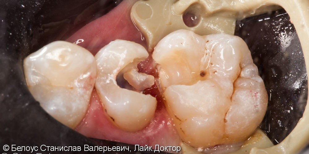 Лечение каналов и установка керамических вкладок, до и после - фото №3