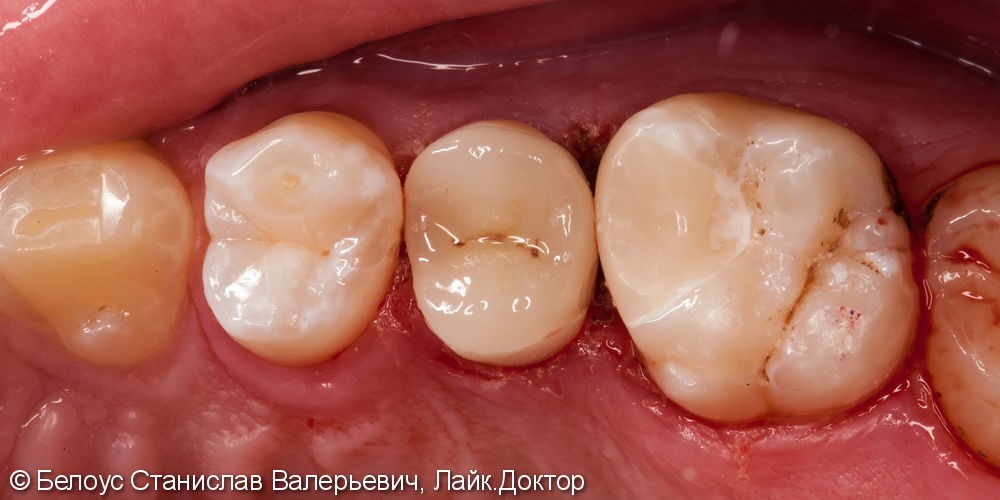 Лечение каналов и установка керамических вкладок, до и после - фото №7