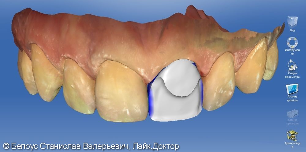 Цельнокерамическоая коронка по технологии Emax CAD на передний зуб - фото №3