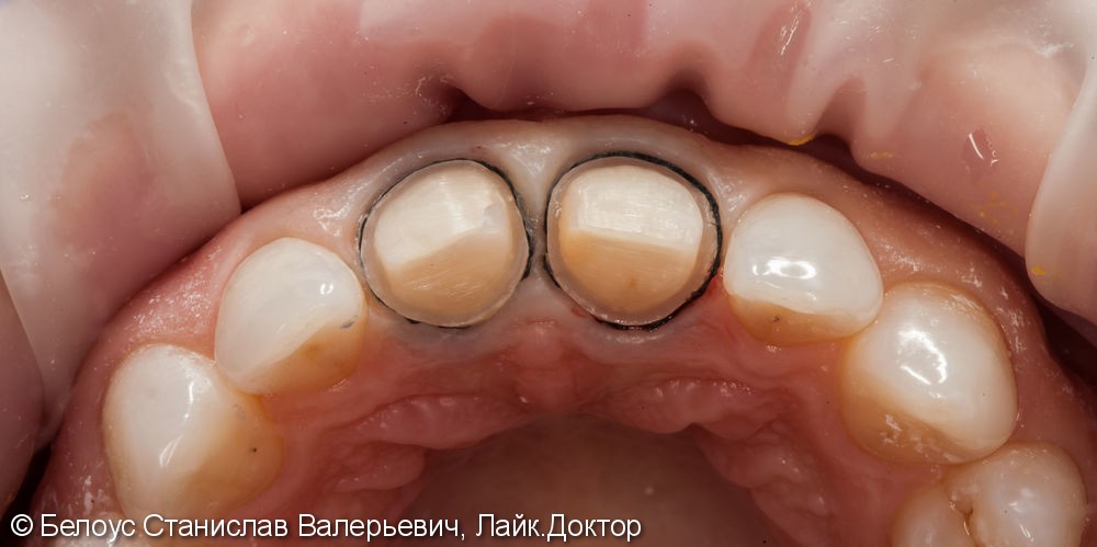 Керамические коронки на передние зубы 11 и 21, результат до и после - фото №4