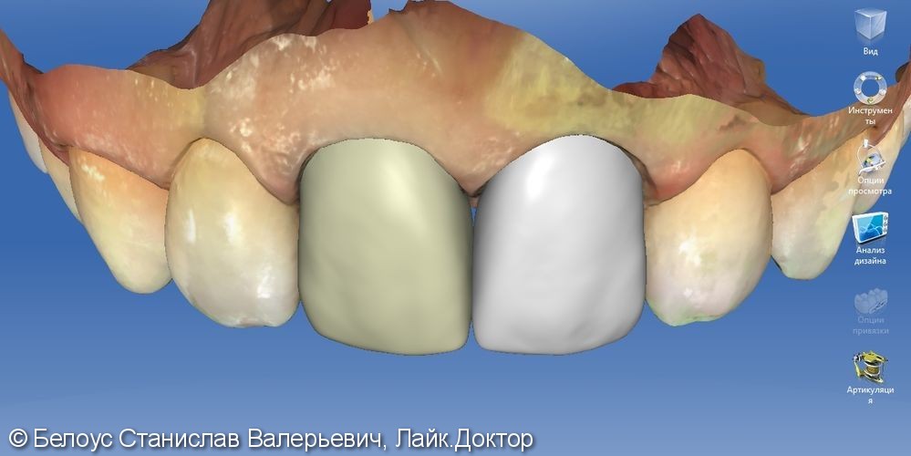 Керамические коронки на передние зубы 11 и 21, результат до и после - фото №6