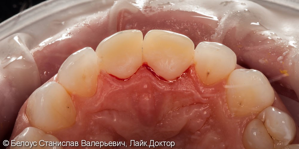 Керамические коронки на передние зубы 11 и 21, результат до и после - фото №9