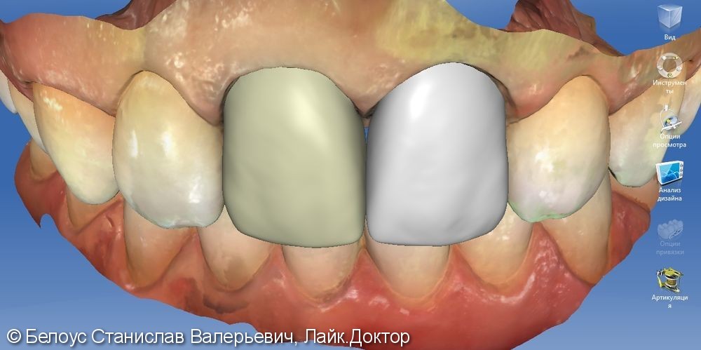 Керамические коронки на передние зубы 11 и 21, результат до и после - фото №11