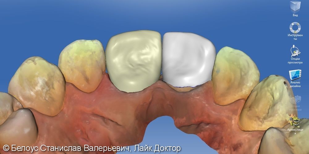 Керамические коронки на передние зубы 11 и 21, результат до и после - фото №13