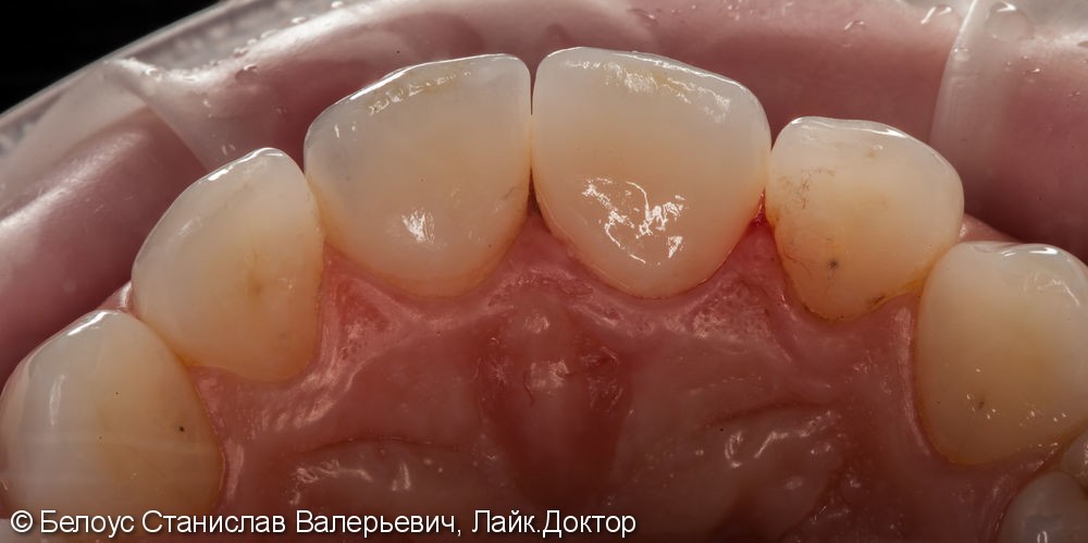 Керамические коронки на передние зубы 11 и 21, результат до и после - фото №18