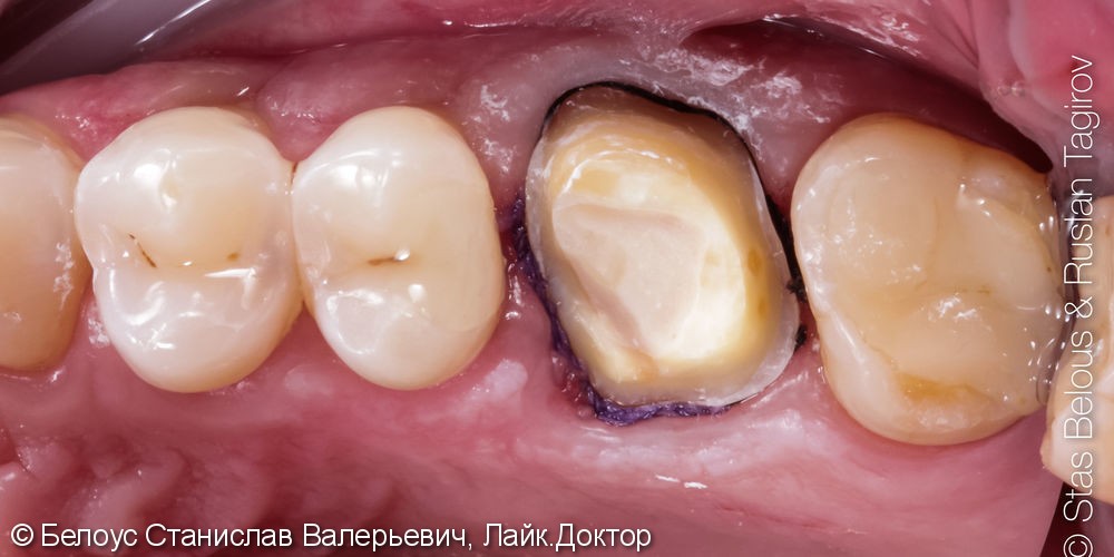 Установка CAD/CAM коронок по технологии CEREC на зубы, Часть 1 - фото №2