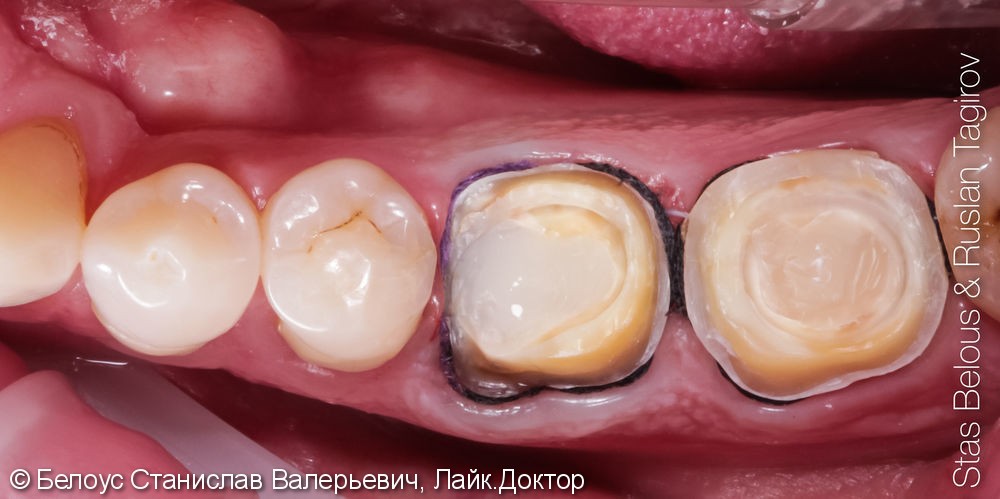 Установка CAD/CAM коронок на коренные зубы 16, 46, 47 Часть 2 - фото №2