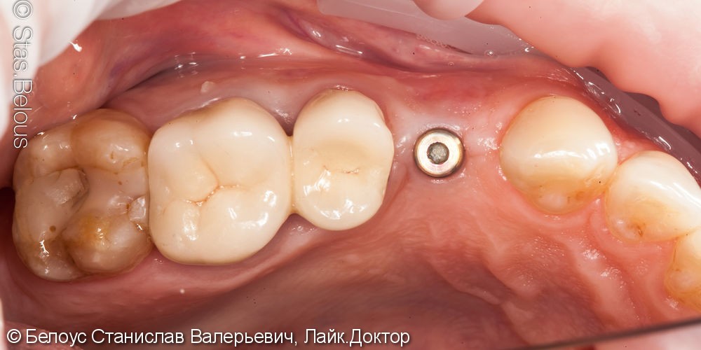 Лечение кариеса и установка коронок на жевательные зубы - фото №1