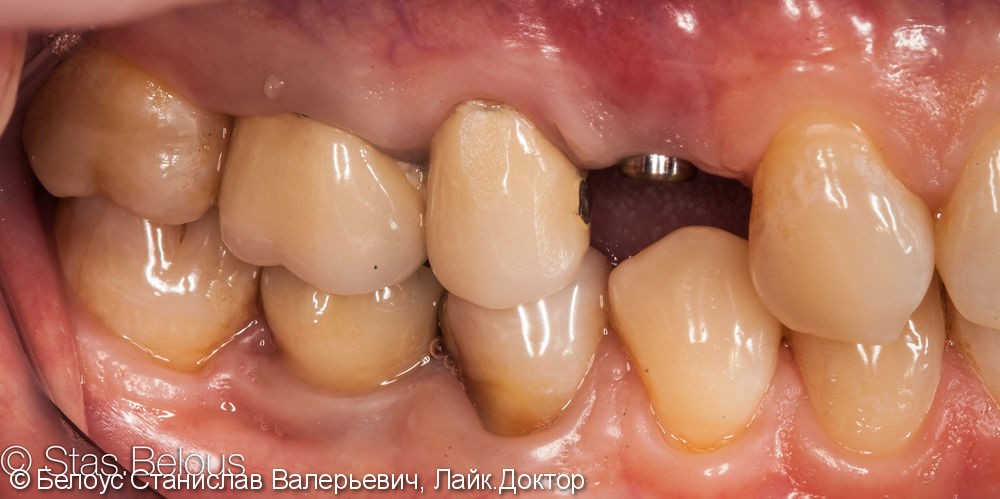 Лечение кариеса и установка коронок на жевательные зубы - фото №2