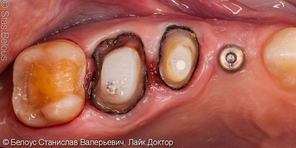Лечение кариеса и установка коронок на жевательные зубы - фото №3