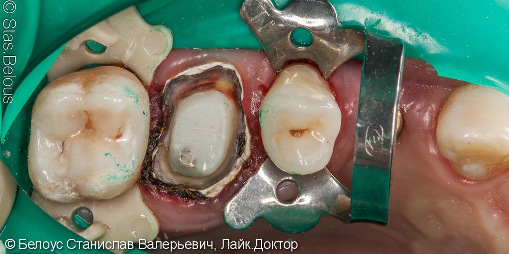 Лечение кариеса и установка коронок на жевательные зубы - фото №7