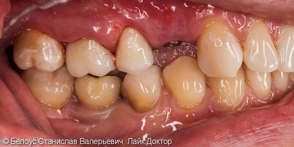 Лечение кариеса и установка коронок на жевательные зубы - фото №8