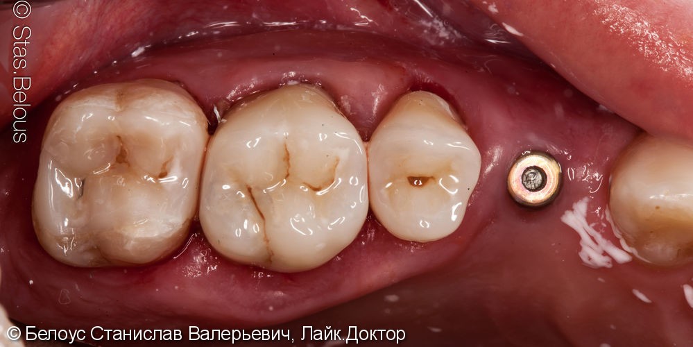 Лечение кариеса и установка коронок на жевательные зубы - фото №9