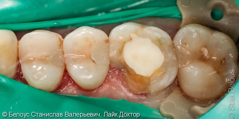 Лечение кариеса и установка cad/cam коронки на жевательных зуб - фото №1