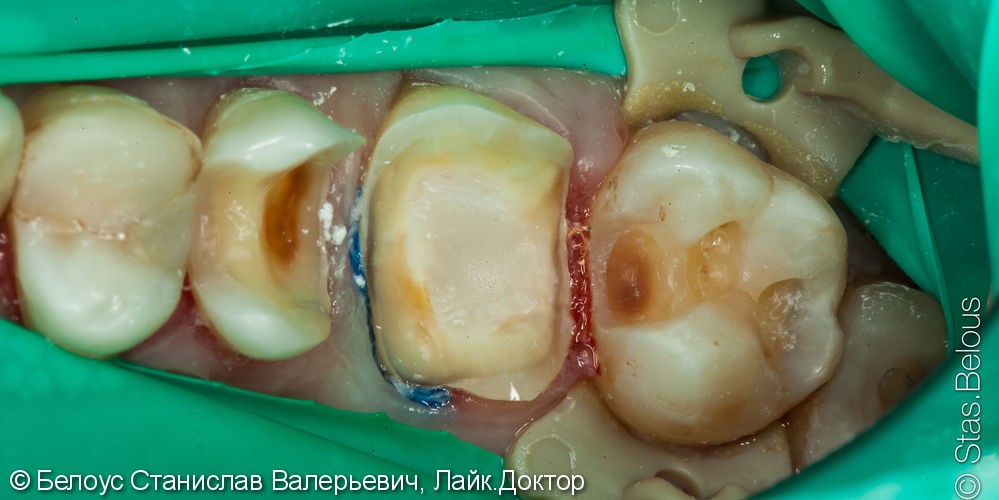 Лечение кариеса и установка cad/cam коронки на жевательных зуб - фото №3
