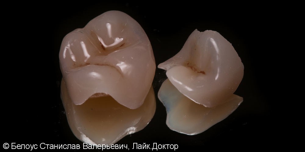 Лечение кариеса и установка cad/cam коронки на жевательных зуб - фото №4
