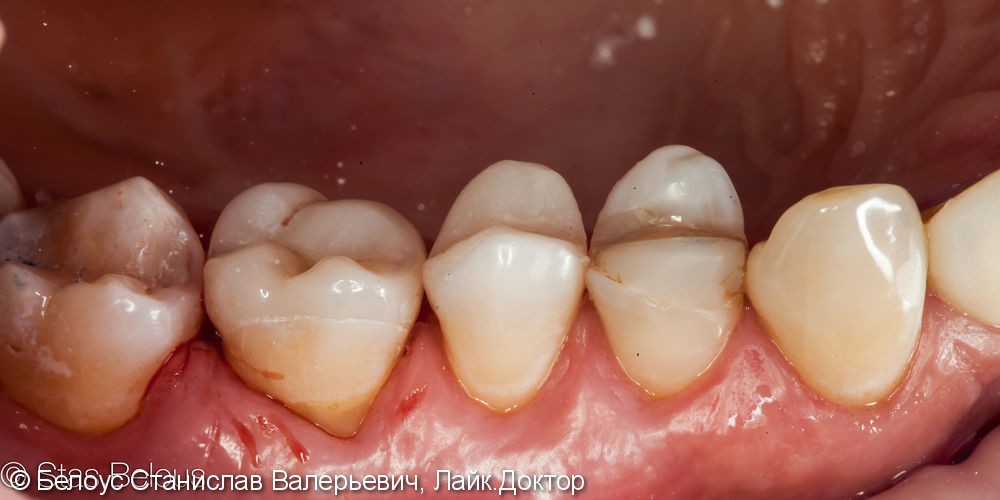 Лечение кариеса и установка cad/cam коронки на жевательных зуб - фото №5