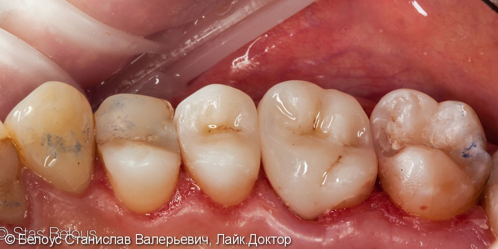 Лечение кариеса и установка cad/cam коронки на жевательных зуб - фото №6