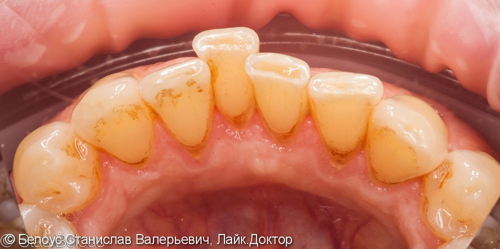 Гигиена полости рта, фото до и после чистки - фото №2