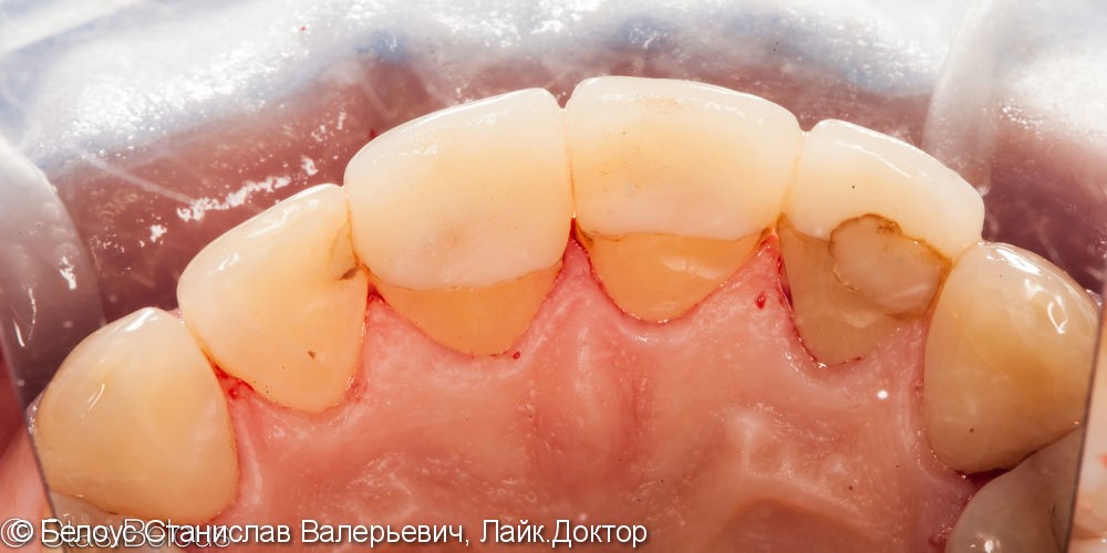Гигиена полости рта, фото до и после чистки - фото №4