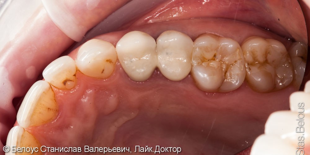 Замена металлокерамических коронок на CAD/CAM цельнокерамические коронки - фото №2