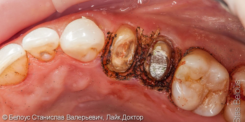Замена металлокерамических коронок на CAD/CAM цельнокерамические коронки - фото №3