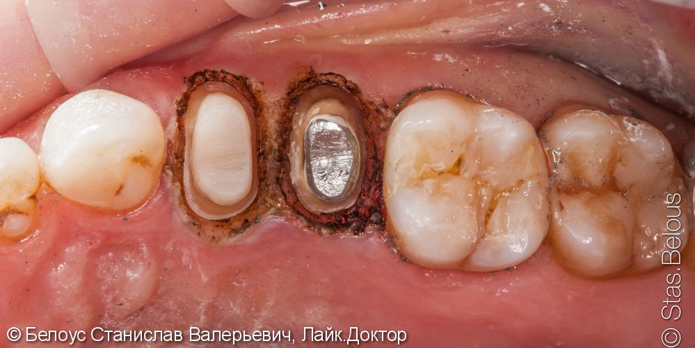Замена металлокерамических коронок на CAD/CAM цельнокерамические коронки - фото №4