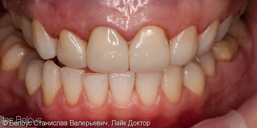 Четыре винира на передние зубы за 2 дня, фото до и после - фото №8