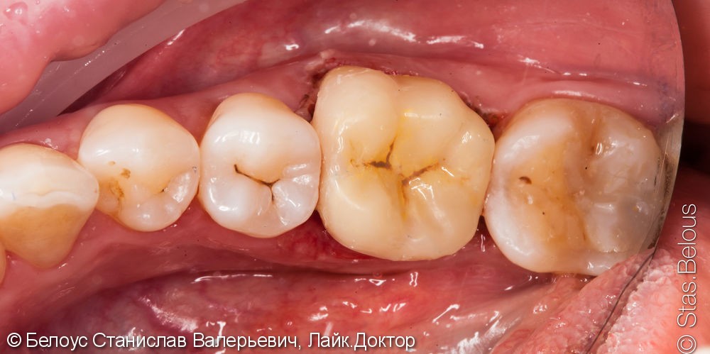 CAD/CAM коронка за 1 визит на жевательный зуб, до и после - фото №5