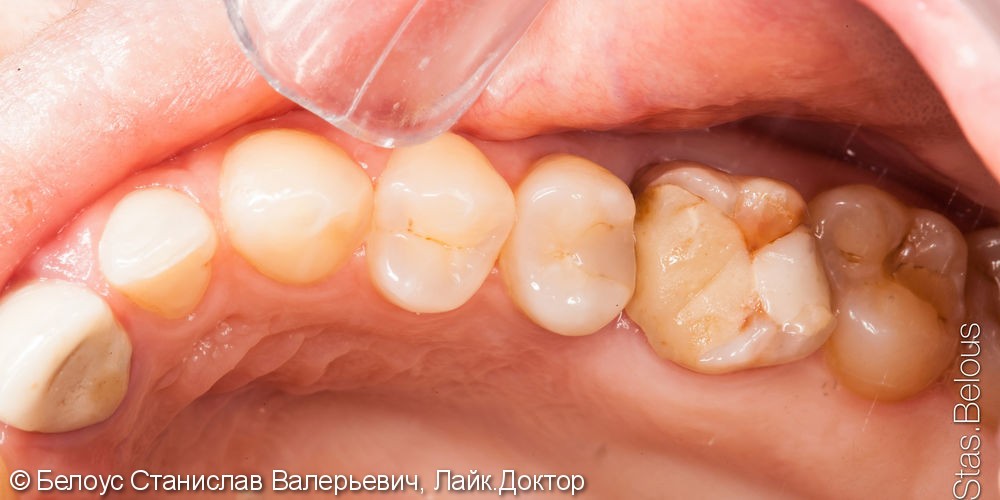 Лечение каналов под микроскопом и установка CAD/CAM коронок из стеклокерамики, до и после - фото №1