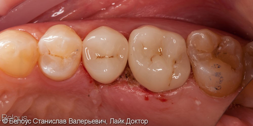 Лечение каналов под микроскопом и установка CAD/CAM коронок из стеклокерамики, до и после - фото №5