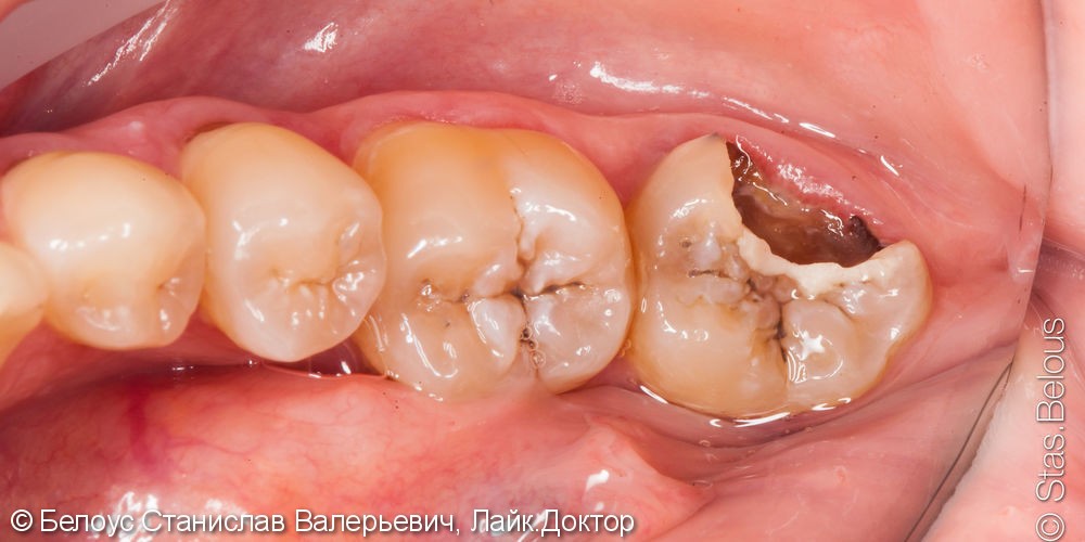 Лечение пульпита под микроскопом, в зубе 3 канала, керамическая полукоронка - фото №1