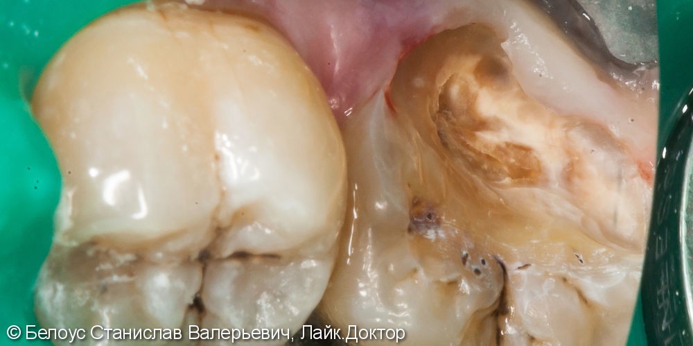 Лечение пульпита под микроскопом, в зубе 3 канала, керамическая полукоронка - фото №2