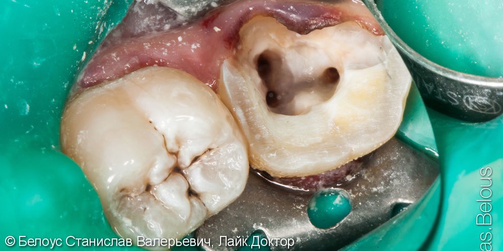 Лечение пульпита под микроскопом, в зубе 3 канала, керамическая полукоронка - фото №4