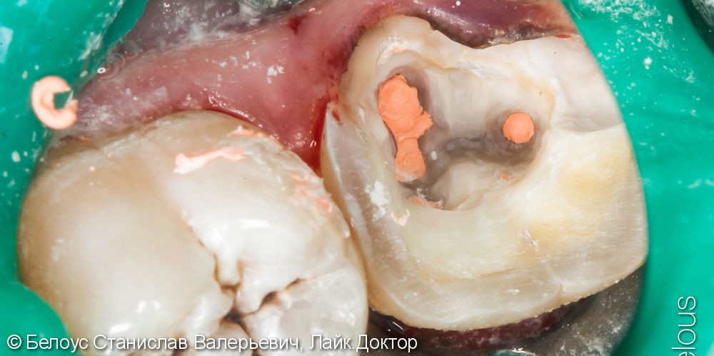 Лечение пульпита под микроскопом, в зубе 3 канала, керамическая полукоронка - фото №5