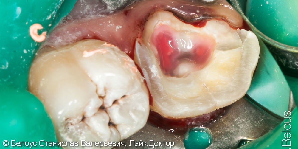 Лечение пульпита под микроскопом, в зубе 3 канала, керамическая полукоронка - фото №6