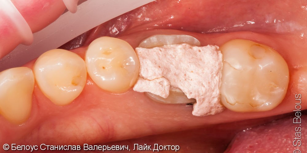 Лечение кариеса зуба 37, лечение каналов в зубе 36, установка CAD/CAM коронок, до и после - фото №1