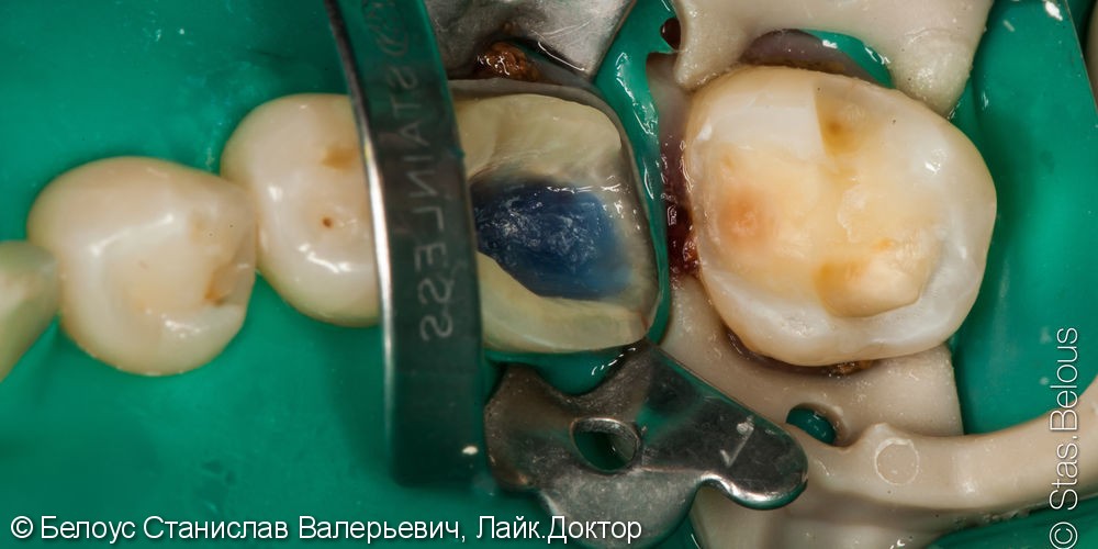 Лечение кариеса зуба 37, лечение каналов в зубе 36, установка CAD/CAM коронок, до и после - фото №3