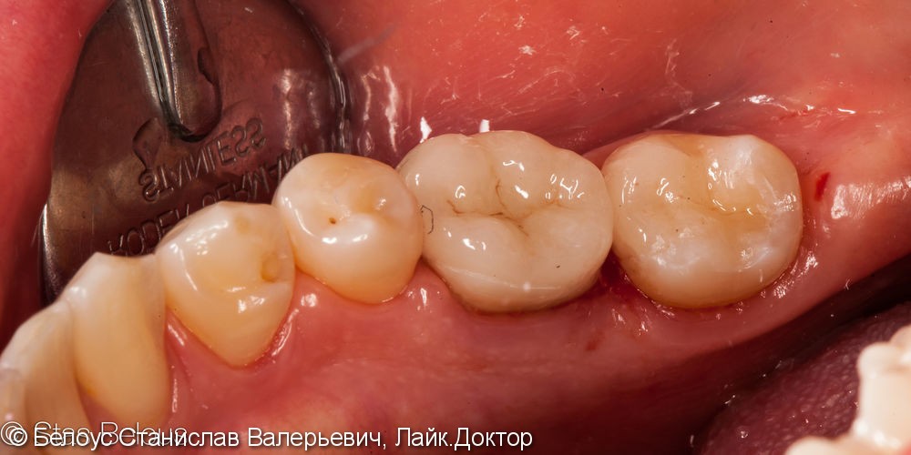 Лечение кариеса зуба 37, лечение каналов в зубе 36, установка CAD/CAM коронок, до и после - фото №4