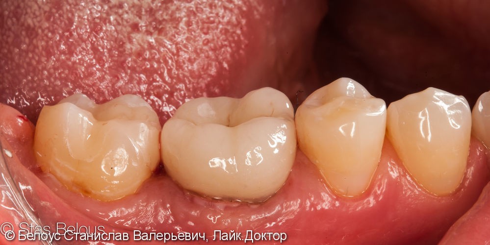 Лечение кариеса зуба 37, лечение каналов в зубе 36, установка CAD/CAM коронок, до и после - фото №5